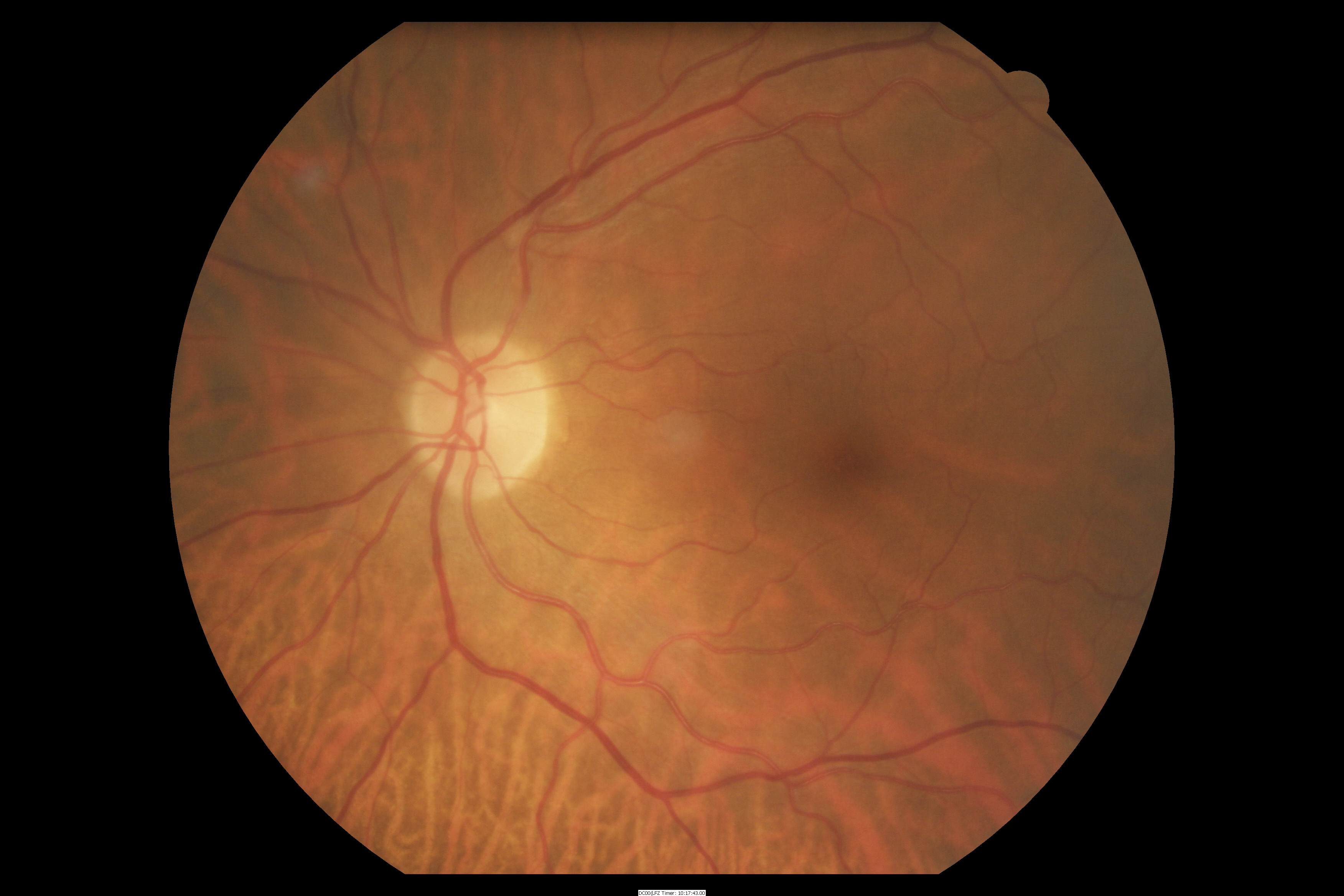 Normal Retina